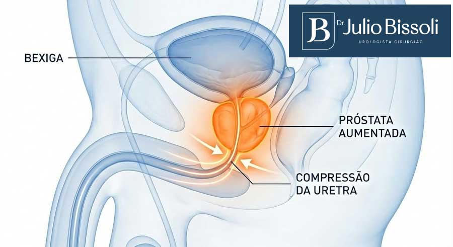 prostata aumentada comprimindo uretra