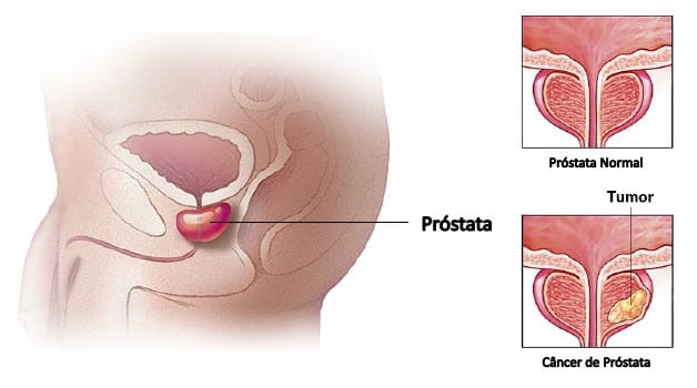Ilustração Câncer de Próstata