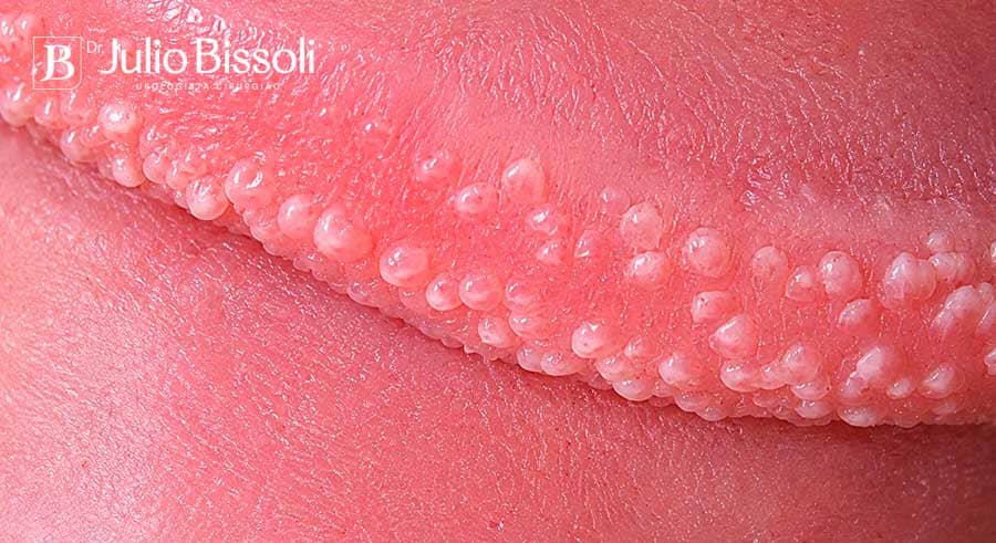 Pápulas perláceas, ou glândulas de Tyson: elevações lisas da cor da pele, enfileiradas ao redor da coroa da glande