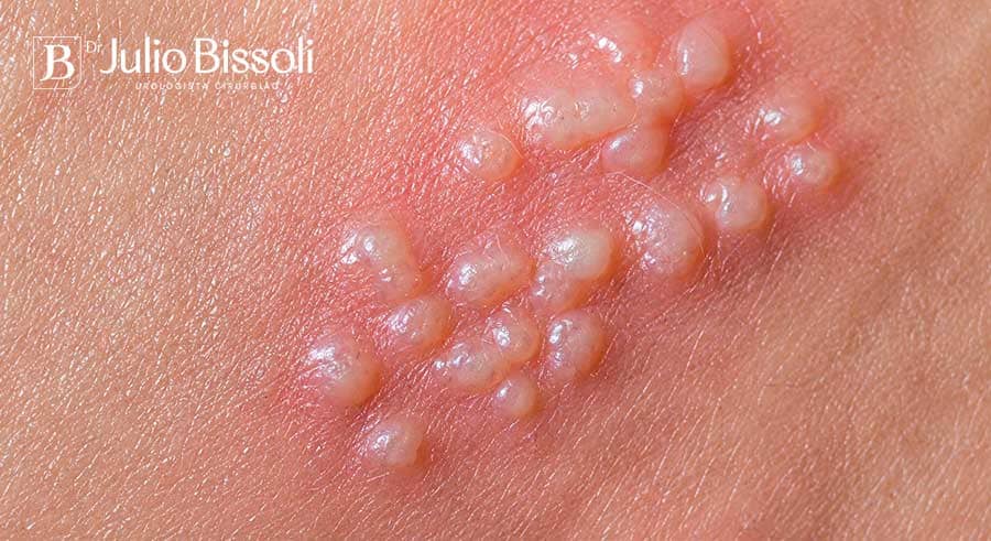 Herpes genital: grupo de pequenas bolhas de conteúdo claro sobre base avermelhada