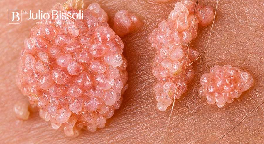 Verrugas genitais por HPV: lesões de superfície irregular, em aspecto de couve-flor, agrupadas na pele