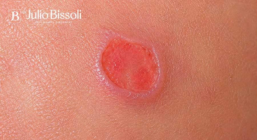 Cancro duro da sífilis primária: úlcera única, arredondada, de bordas firmes e fundo limpo